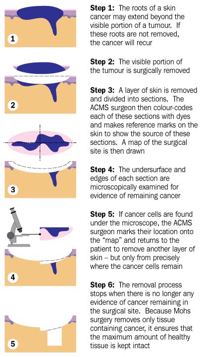 Mohs Table of Surgical Procedures: A Comprehensive Guide for Precise and Optimal Surgical Outcomes