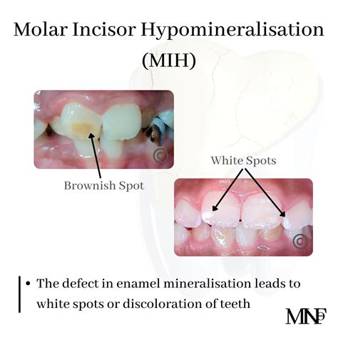 Molar-incisor hypomineralization (MIH)