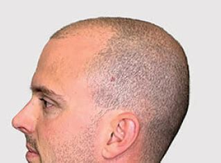 Monofilament Technology: A Seamless Scalp Illusion