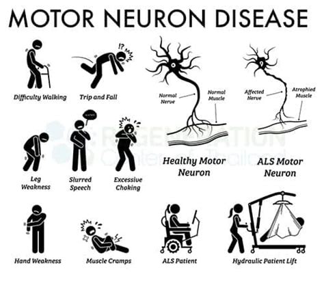 Motor Neuron Diseases Causes Reader