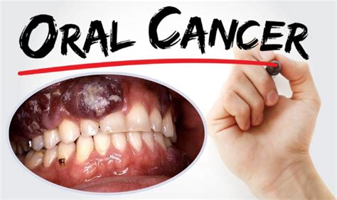 Mouth Cancer from Zyn: A Growing Epidemic