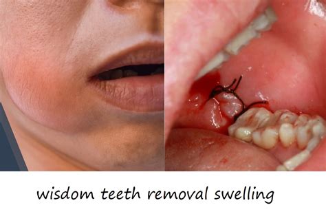 Mouth Swollen After Wisdom Tooth Removal: Essential Guide for 2025