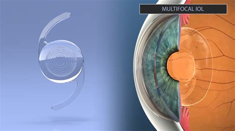 Multifocal IOLs Reader