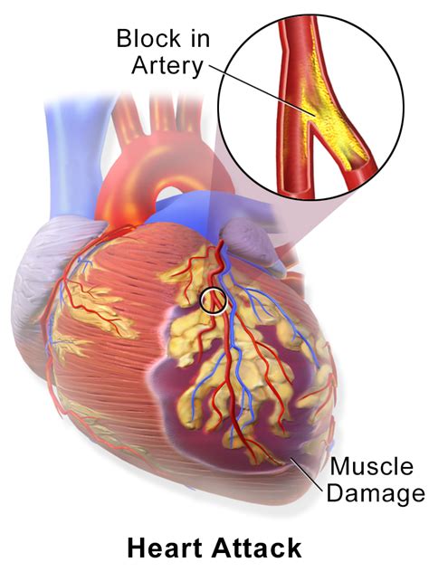 Myocardial infarction (heart attack):