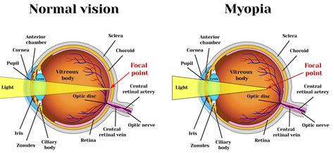 Myopia (Nearsightedness):