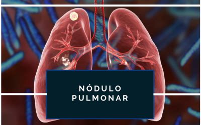 NÓDULO PULMONAR ISOLADO: UM GUIA COMPLETO PARA PACIENTES