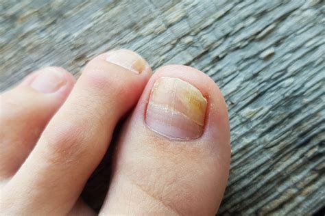 Nail Fungus: