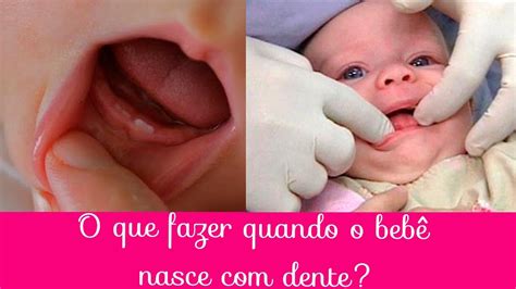 Nascer dos Dentes: Um Guia Completo para Pais