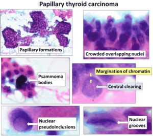 Navigating the Complexities of Papillary Thyroid Cancer with ICD-10