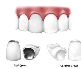 Navigating the Financial Maze of Dental Crowns