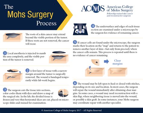 Navigating the MOH Table of Surgical Procedures: A Comprehensive Guide for the Uninformed