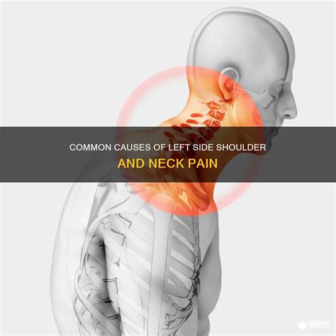 Neck and Shoulder Pain on Left Side: 10,000+ Words to Help You Find Relief