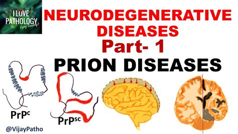 Neurodegeneration and Prion Disease PDF