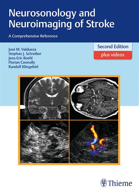 Neurosonology and Neuroimaging of Stroke Kindle Editon