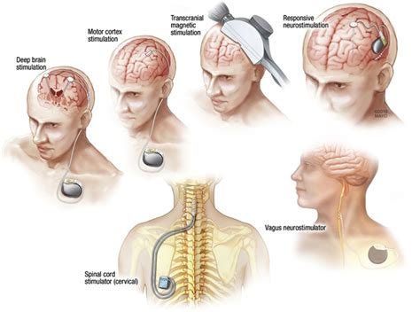 Neurostimulation Techniques: