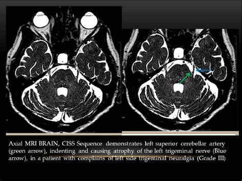 Neurovascular Imaging MRI & Microangiography Kindle Editon