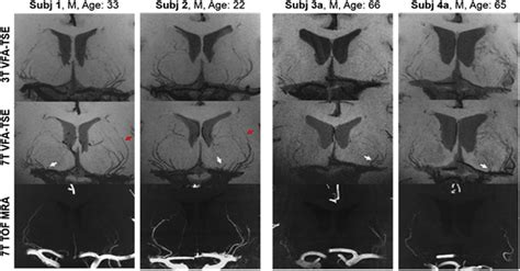 Neurovascular Imaging MRI & Microangiography Kindle Editon