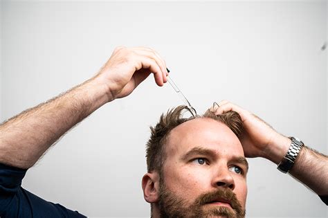 Niall Boylan Perücke: Die ultimative Lösung für Haarprobleme