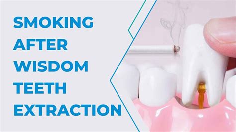 Nicotine after Wisdom Teeth Removal: Essential Tips for a Healing Recovery