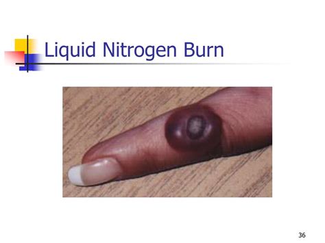 Nitrogen burns: