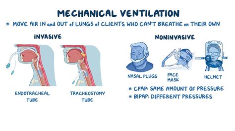 Non Invasive Artificial Ventilation How Kindle Editon