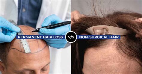 Non-Surgical Hair Replacement: Revolutionary Solutions for Hair Loss