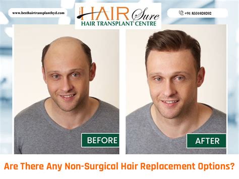 Non-Surgical Hair Replacement Options