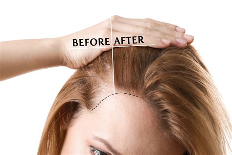 Non-Surgical Hair Restoration Techniques: