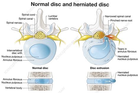 Normal Discs: