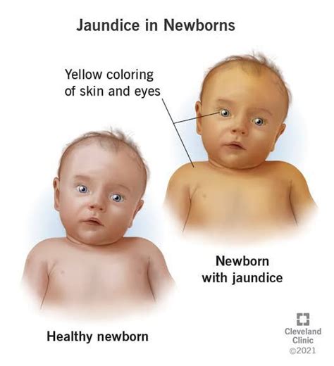 Normal Range of Jaundice in Newborns: A Comprehensive Guide (0-14 Days)