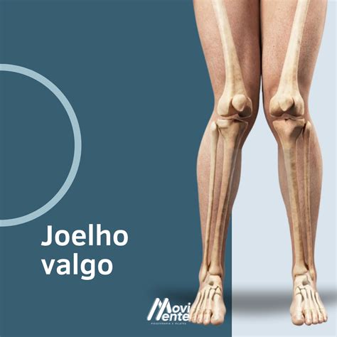 O Guia Completo para Compreender e Abordar o Joelho Valgo e Varo: Corrigindo os Desvios do Joelho