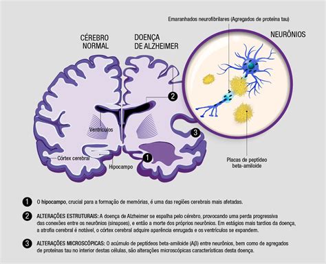 O Papel da Aβ na Doença de Alzheimer