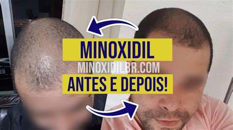 O Poder do Minoxidil Oral