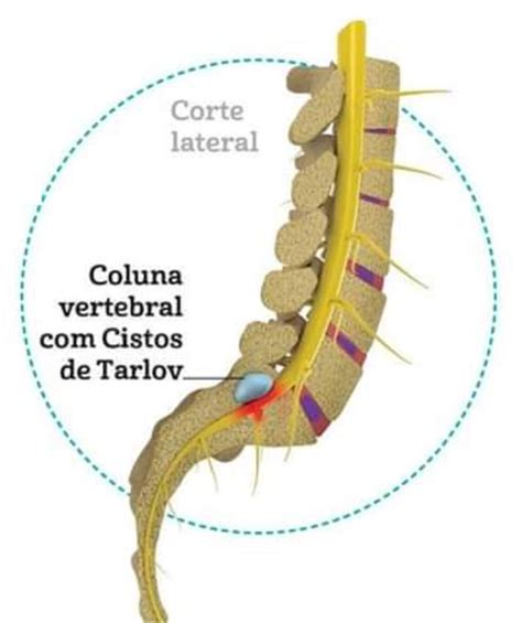 O Segredo Revelado: Desbloqueando o Mistério do Cisto de Tarlov