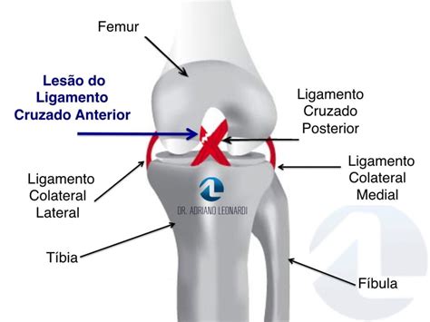 O que é Rompimento do Ligamento Cruzado Anterior?