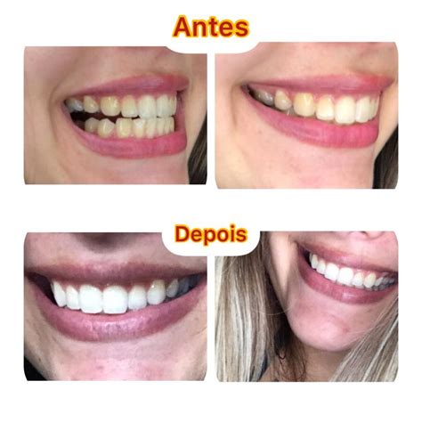 O que é clareamento dental caseiro?