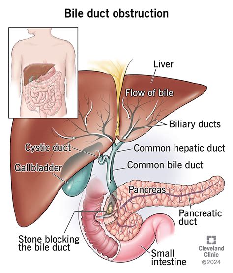 Obstruction of Bile Duct: A Comprehensive Guide to 4 Causes, 5 Symptoms, and 6 Treatment Options