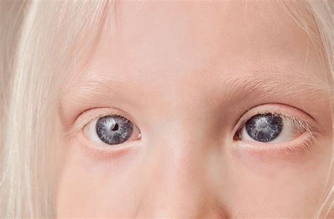 Ocular albinism (OA)