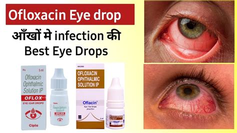 Ofloxacin Eye Drops: A Comprehensive Guide to Uses, Benefits, and Safety