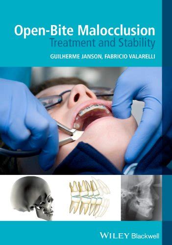 Open-Bite Malocclusion Treatment and Stability Epub