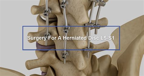 Operation for Slipped Disc in Back: 2025 Analysis