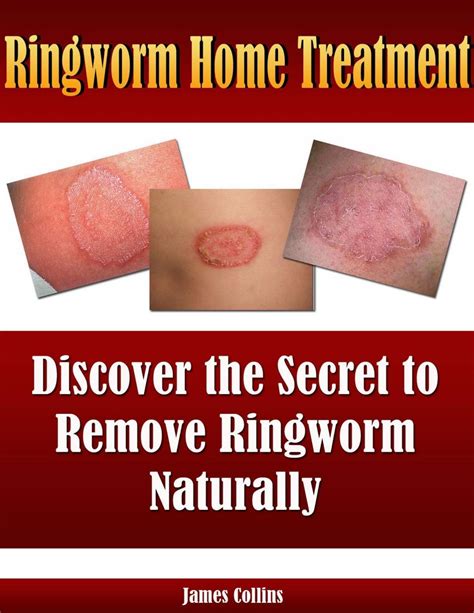 Oral Medication for Ringworm: A Comprehensive Guide to Effective Treatment