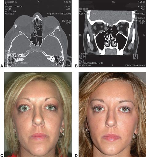 Orbital Surgery Reader