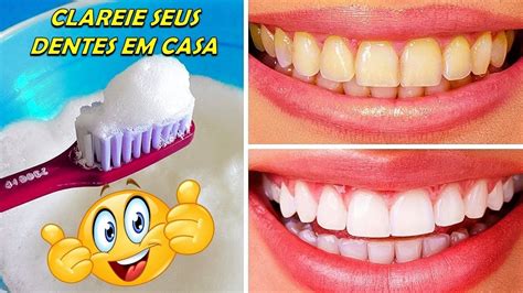 Os Benefícios de Usar um Gel Clareador dos Dentes