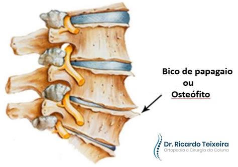 Osteófitos Marginais nos Corpos Vertebrais: Um Guia Completo