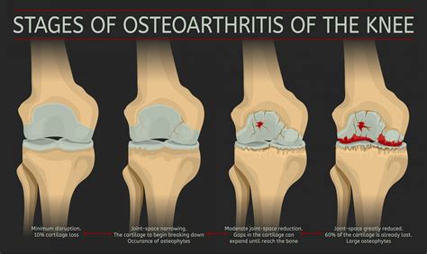 Osteoarthritis Reader