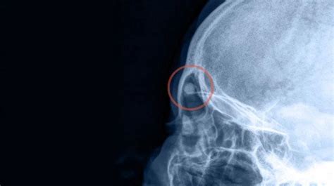 Osteoma: O Que É, Riscos e Tratamento