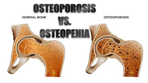 Osteopenia