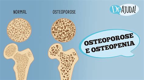 Osteopenia: Entenda o Que É, Causas e Tratamento