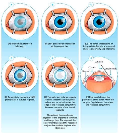 Outis Limbus: A Beacon of Hope for Limbal Stem Cell Transplantation